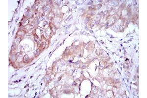 Immunohistochemical analysis of paraffin-embedded lung cancer using MTHFR mouse mAb with DAB staining. (MTHFR Antikörper)