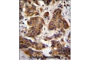 C4orf21 Antibody (N-term) (ABIN655214 and ABIN2850480) immunohistochemistry analysis in formalin fixed and paraffin embedded human bladder carcinoma followed by peroxidase conjugation of the secondary antibody and DAB staining. (ZGRF1 Antikörper  (N-Term))