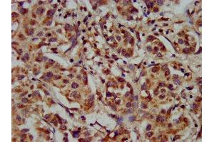 IHC image of ABIN7142850 diluted at 1:300 and staining in paraffin-embedded human liver cancer performed on a Leica BondTM system. (CYP8B1 Antikörper  (AA 303-440))