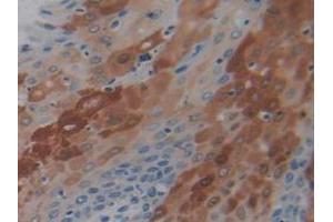 IHC-P analysis of Human Stomach Cancer Tissue, with DAB staining. (PD-1 Antikörper  (AA 41-132))