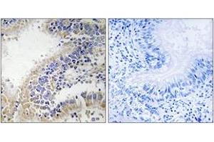 Immunohistochemistry analysis of paraffin-embedded human breast carcinoma tissue, using DHODH Antibody. (DHODH Antikörper  (AA 211-260))