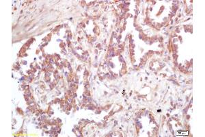 Formalin-fixed and paraffin embedded human lung carcinoma labeled with Rabbit Anti ATP6IP2 Polyclonal Antibody, Unconjugated (ABIN872738) at 1:200 followed by conjugation to the secondary antibody and DAB staining
