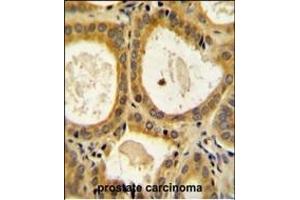 CTLA4 Antibody (N-term) (ABIN654422 and ABIN2844157) immunohistochemistry analysis in formalin fixed and paraffin embedded human prostate carcinoma followed by peroxidase conjugation of the secondary antibody and DAB staining. (CTLA4 Antikörper  (AA 50-78))