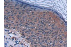 IHC-P analysis of Human Skin cancer Tissue, with DAB staining. (CCL27 Antikörper  (AA 25-112))