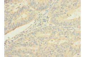 Immunohistochemistry of paraffin-embedded human endometrial cancer using ABIN7173241 at dilution of 1:100 (TMEM56 Antikörper  (AA 232-263))