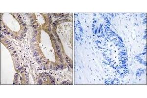 Immunohistochemistry analysis of paraffin-embedded human colon carcinoma tissue, using STK24 Antibody. (STK24 Antikörper  (AA 319-368))