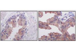 Immunohistochemical analysis of paraffin-embedded human normal prostate tissues (left) and prostate adenocarcinoma tissues (right), showing cytoplasmic localization using AMACR mouse mAb with DAB staining. (AMACR Antikörper)