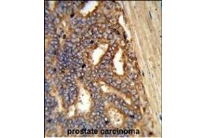 Formalin-fixed and paraffin-embedded human prostate carcinoma reacted with Y1A Antibody (Center), which was peroxidase-conjugated to the secondary antibody, followed by DAB staining.