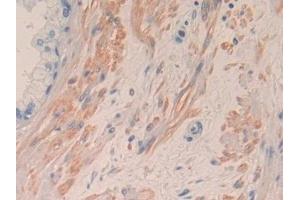 Detection of IL8 in Human Prostate Tissue using Monoclonal Antibody to Interleukin 8 (IL8) (IL-8 Antikörper  (AA 28-99))