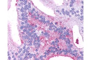 Anti-GPR88 antibody IHC of human Prostate, Carcinoma. (GPR88 Antikörper  (C-Term))