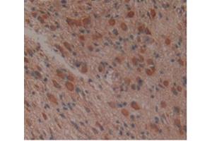 IHC-P analysis of Human Glioma Tissue, with DAB staining. (APOA1BP Antikörper  (AA 118-282))