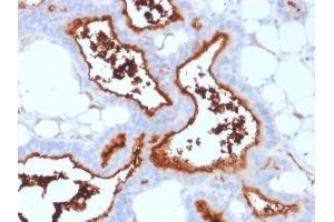 Formalin-fixed, paraffin-embedded human Lung Carcinoma stained with CD73 Mouse Monoclonal Antibody (NT5E/2503). (CD73 Antikörper)