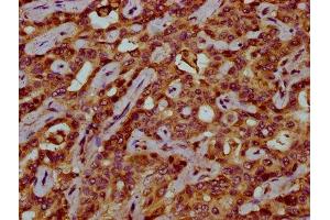 IHC image of ABIN7175529 diluted at 1:200 and staining in paraffin-embedded human liver cancer performed on a Leica BondTM system. (VKORC1 Antikörper  (AA 30-74))