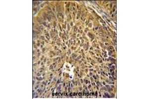 EIF3G Antibody (Center) (ABIN651535 and ABIN2840284) immunohistochemistry analysis in formalin fixed and paraffin embedded human cervix carcinoma followed by peroxidase conjugation of the secondary antibody and DAB staining.