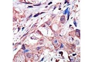 IHC analysis of FFPE human breast carcinoma tissue stained with the JNK3 antibody (MAPK10 Antikörper  (AA 1-30))