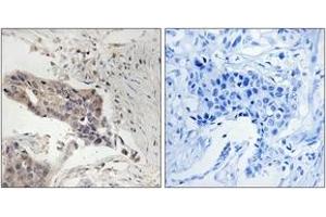 Immunohistochemistry analysis of paraffin-embedded human breast carcinoma tissue, using SLP-76 (Ab-128) Antibody. (LCP2 Antikörper  (AA 94-143))