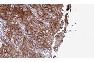 ABIN6277320 at 1/100 staining Human Head and neck cancer tissue by IHC-P. (CLEC4A Antikörper  (C-Term))