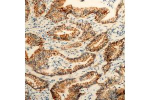 Immunohistochemical analysis of PEX11B staining in human colon cancer formalin fixed paraffin embedded tissue section. (PEX11B Antikörper  (Center))