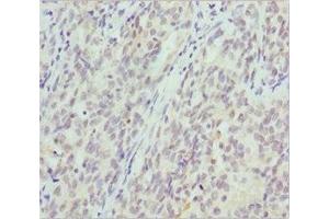 Immunohistochemistry of paraffin-embedded human lung cancer using ABIN7145471 at dilution of 1:100 (CRYGS Antikörper  (AA 1-178))
