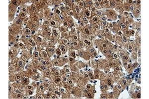 Immunohistochemical staining of paraffin-embedded Adenocarcinoma of Human endometrium tissue using anti-QPRT mouse monoclonal antibody. (QPRT Antikörper)