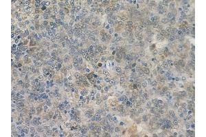 ABIN6259173 and ABIN6273776 at 1/100 staining human melanoma by IHC-P.