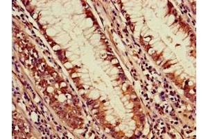 Immunohistochemistry of paraffin-embedded human colon cancer using ABIN7169756 at dilution of 1:100 (PDS5A Antikörper  (AA 2-134))