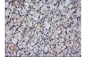 Immunohistochemical staining of paraffin-embedded Carcinoma of Human kidney tissue using anti-RASSF1 mouse monoclonal antibody. (RASSF1 Antikörper)