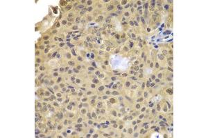 Immunohistochemistry of paraffin-embedded human well-differentiated squamous skin carcinoma using CCNA2 antibody. (Cyclin A Antikörper)