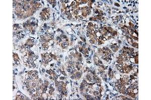 Immunohistochemical staining of paraffin-embedded Carcinoma of liver tissue using anti-LIPG mouse monoclonal antibody. (LIPG Antikörper)