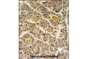 IN80D Antibody IHC analysis in formalin fixed and paraffin embedded human hepatocarcinoma followed by peroxidase conjugation of the secondary antibody and DAB staining. (IN80D Antikörper  (N-Term))