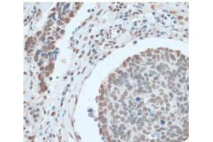 Immunohistochemistry of paraffin-embedded Human lung cancer using ZNF433 Polyclonal Antibody at dilution of 1:100 (40x lens).