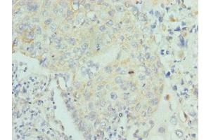 Immunohistochemistry of paraffin-embedded human lung cancer using ABIN7158582 at dilution of 1:100 (LUM Antikörper  (AA 19-338))