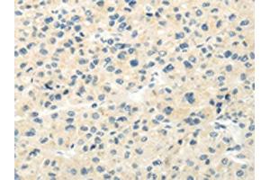 The image on the left is immunohistochemistry of paraffin-embedded Human liver cancer tissue using ABIN7193018(VIPR1 Antibody) at dilution 1/20, on the right is treated with synthetic peptide. (VIPR1 Antikörper)