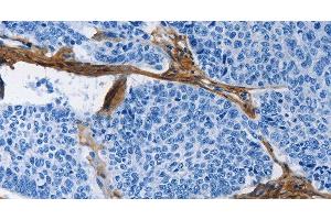 Immunohistochemistry of paraffin-embedded Human lung cancer tissue using COL3A1 Polyclonal Antibody at dilution 1:60 (COL3A1 Antikörper)