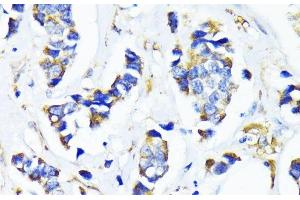 Immunohistochemistry of paraffin-embedded Human breast cancer using MRPL45 Polyclonal Antibody at dilution of 1:100 (40x lens).