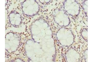 Immunohistochemistry of paraffin-embedded human colon cancer using ABIN7160702 at dilution of 1:100 (GCNT2 Antikörper  (AA 203-402))