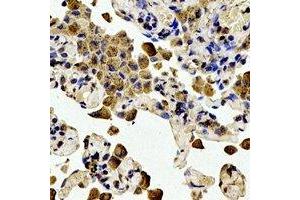 Immunohistochemical analysis of BCL2 (pT56) staining in human lung cancer formalin fixed paraffin embedded tissue section. (Bcl-2 Antikörper  (pSer56))