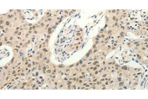 Immunohistochemistry of paraffin-embedded Human lung cancer tissue using Frizzled 10 Polyclonal Antibody at dilution 1:50 (FZD10 Antikörper)