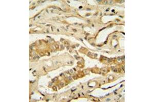 Immunohistochemistry analysis in formalin fixed and paraffin embedded human lung tissue reacted with NDUF3 Antibody (N-term) followed which was peroxidase conjugated to the secondary antibody and  followed by DAB staining. (NDUFAF3 Antikörper  (N-Term))