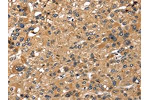 The image on the left is immunohistochemistry of paraffin-embedded Human liver cancer tissue using ABIN7191289(LONP1 Antibody) at dilution 1/25, on the right is treated with synthetic peptide. (LONP1 Antikörper)