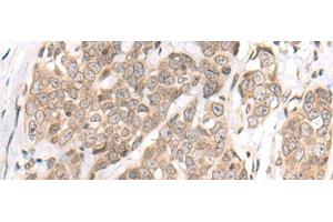 Immunohistochemistry of paraffin-embedded Human thyroid cancer tissue using M1AP Polyclonal Antibody at dilution of 1:80(x200) (Meiosis 1 Associated Protein (M1AP) Antikörper)