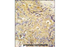 Formalin-fixed and paraffin-embedded human prostata carcinoma tissue reacted with FGF10 antibody , which was peroxidase-conjugated to the secondary antibody, followed by DAB staining. (FGF10 Antikörper  (C-Term))