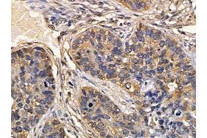 FMR1 Mouse Monoclonal Antibody at 1/100 staining human lung cancer and adjacent non-tumor tissue by IHC-P. (FMR1 Antikörper  (Internal Region))