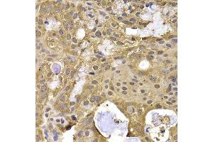 Immunohistochemistry of paraffin-embedded human oophoroma using NAA20 antibody. (NAT5 Antikörper  (AA 49-178))