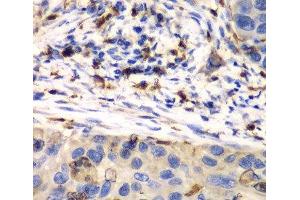 Immunohistochemistry of paraffin-embedded Human esophageal cancer using S100A8 Polyclonal Antibody at dilution of 1:100 (40x lens). (S100A8 Antikörper)