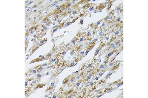 Immunohistochemistry of paraffin-embedded human liver cancer using BMP2 Rabbit pAb (ABIN3020733, ABIN3020734, ABIN1512642, ABIN1513827 and ABIN6213697) at dilution of 1:100 (40x lens). (BMP2 Antikörper  (AA 283-396))