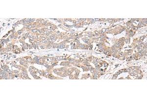 Immunohistochemistry of paraffin-embedded Human liver cancer tissue using CHST4 Polyclonal Antibody at dilution of 1:35(x200) (CHST4 Antikörper)