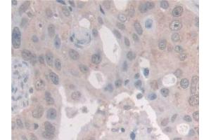 Detection of NCOA3 in Human Breast cancer Tissue using Polyclonal Antibody to Nuclear Receptor Coactivator 3 (NCOA3) (NCOA3 Antikörper  (AA 1023-1304))