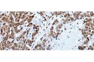Immunohistochemistry of paraffin-embedded Human thyroid cancer tissue using CELF5 Polyclonal Antibody at dilution of 1:65(x200) (CELF5 Antikörper)