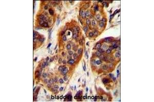 LRRC57 Antibody (C-term) (ABIN654494 and ABIN2844226) immunohistochemistry analysis in formalin fixed and paraffin embedded human bladder carcinoma followed by peroxidase conjugation of the secondary antibody and DAB staining. (LRRC57 Antikörper  (C-Term))